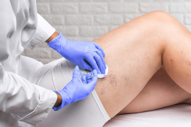 Escleroterapia
